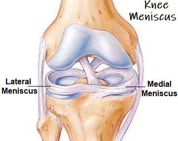 Arthroscopic Meniscus Repair